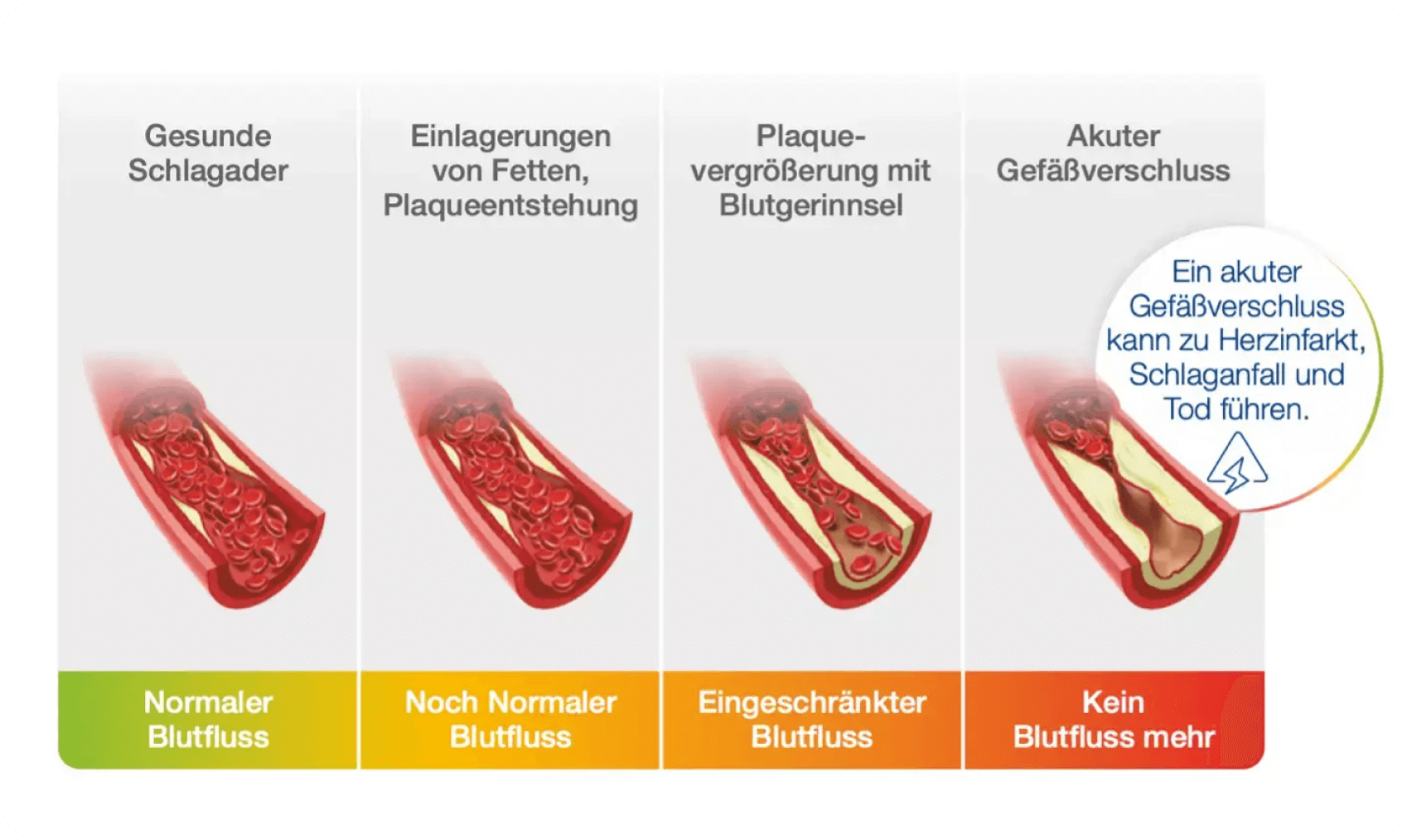 Darstellung der Entstehung von Athereosklerose durch LDL-Erhöhung